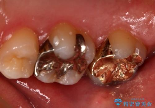 奥歯の再治療をしたい ゴールドインレーの治療後