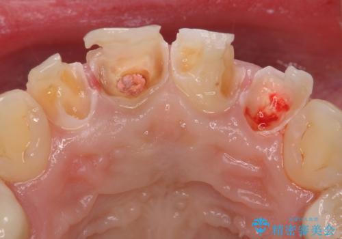 虫歯だらけの前歯をセラミック治療の治療中