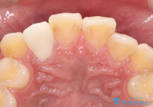 【セラミッククラウン】【精密根管治療】前歯が痛いの治療後