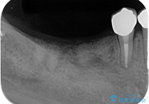 遊離歯肉移植術を伴うインプラント治療の治療前