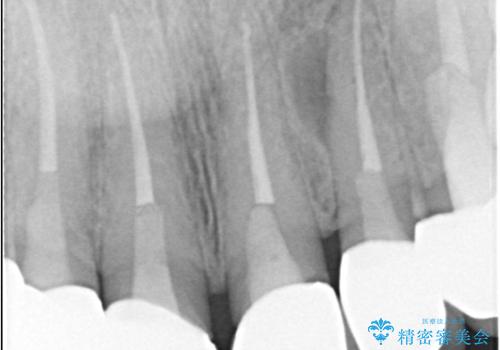 前歯の破折も1日で解決!抜歯即時インプラントで自然な笑顔への治療前