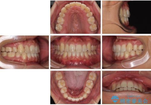八重歯と前歯のガタガタを抜歯矯正で治療|クリアブラケット使用例の治療後