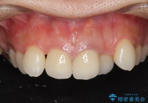 著しいがたつきによる清掃困難  歯牙抜去とセラミック治療の症例 治療後