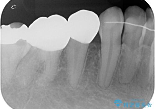 銀歯を白くしたい フルジルコニアクラウンの治療後