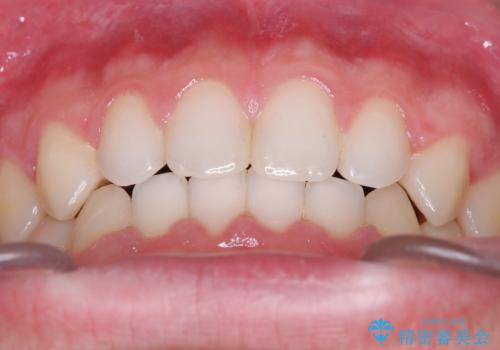 【ワイヤー矯正】歯列の隙間を閉じたいの治療後