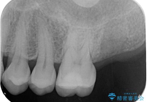 噛むと歯が疼く 歯牙破折からのインプラント治療の治療中