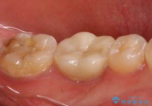 左下奥歯が腫れて痛い　フルジルコニアクラウンの治療前