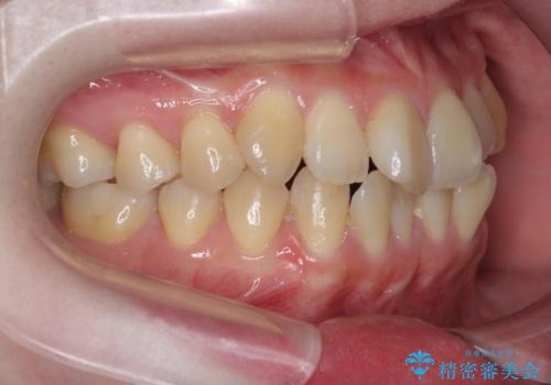 前歯のねじれ 矯正治療による歯並び改善の治療前