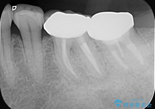 奥歯の痛みも、顕微鏡で精密に解消の治療後