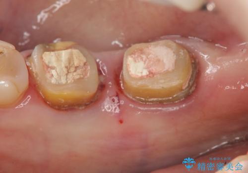 [ 奥歯の歯周病 ] エムドゲインを用いた再生治療の治療中
