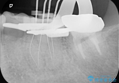 奥歯の痛みも、顕微鏡で精密に解消の治療中