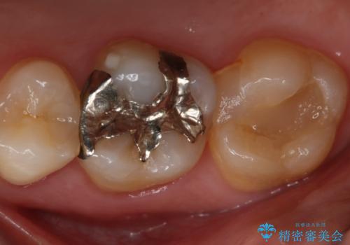 奥歯の再治療をしたい　ゴールドインレーの症例 治療前