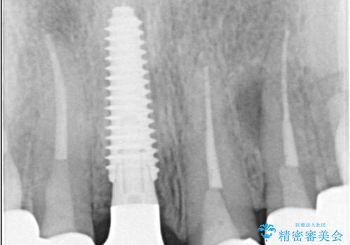 前歯の破折も1日で解決!抜歯即時インプラントで自然な笑顔への治療後