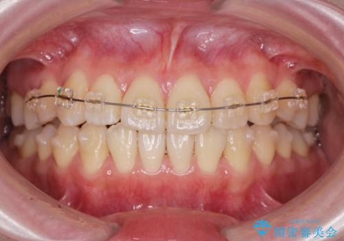 前歯のねじれ 矯正治療による歯並び改善の治療前