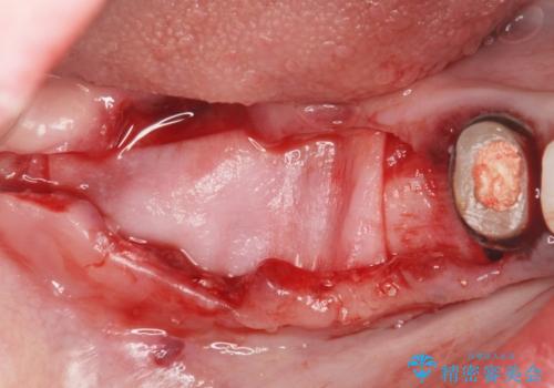 遊離歯肉移植術を伴うインプラント治療の治療前