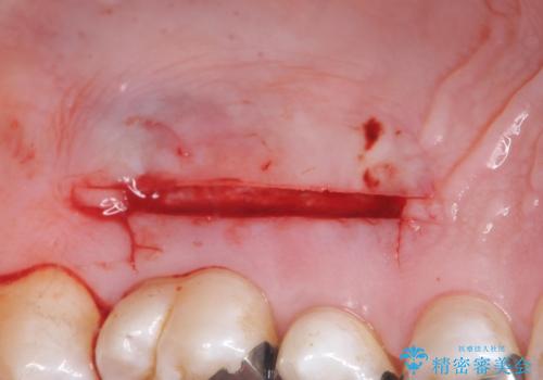 歯肉退縮に対する結合組織移植の治療中