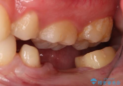 銀歯をやり変えたい フルジルコニアブリッジの治療中