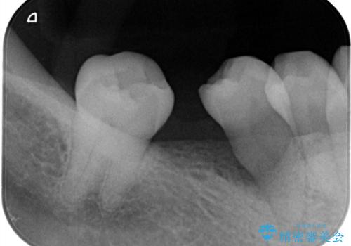 歯周病治療、部分矯正、インプラントを組み合わせた奥歯の治療の治療前