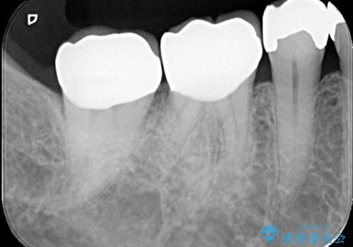 銀歯の下の虫歯|オールセラミッククラウンの治療後
