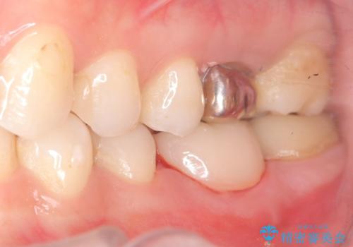 【歯牙移植】奥歯抜歯と言われたので親知らずを移植してほしいの治療後
