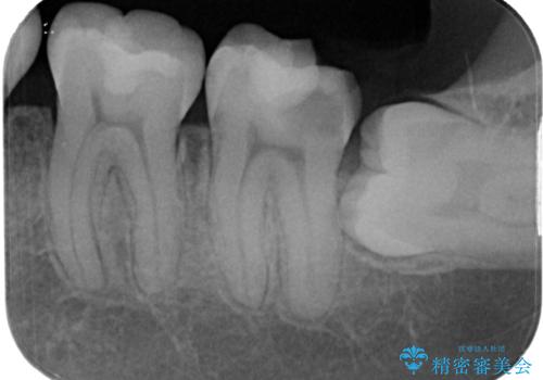 左下の奥歯が欠けた フルジルコニアクラウン・親知らず抜歯の治療前