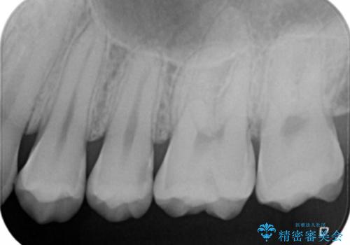 奥歯を治療したい フルジルコニアクラウンの治療前