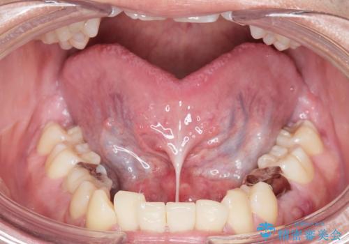 舌小帯を切りたい。の治療前