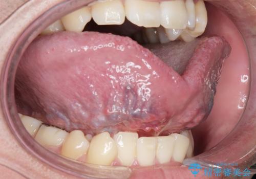 舌小帯を切りたい。の治療前