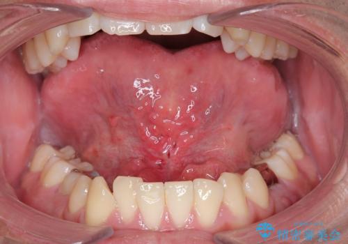 舌小帯を切りたい。の治療後