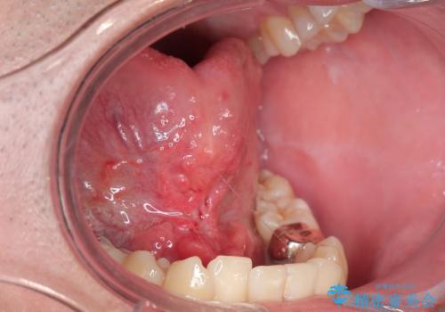 舌小帯を切りたい。の治療後