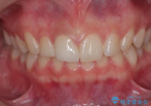前歯が欠けた。の治療後