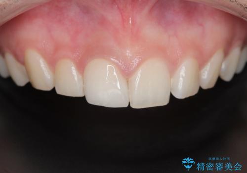 前歯が欠けた。の治療後