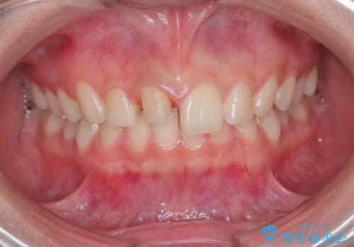 前歯が欠けた。の治療中