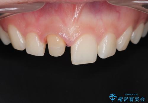 前歯が欠けた。の治療中