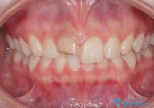 前歯が欠けた。の治療前