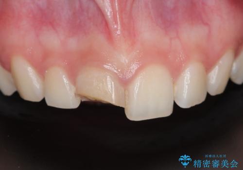 前歯が欠けた。