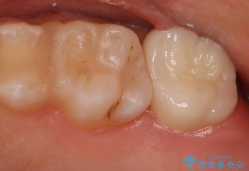 奥歯を治療したい フルジルコニアクラウンの治療後