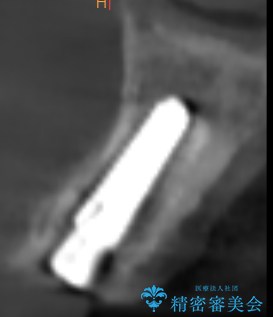 前歯の隙間とへこみが舌で触ると気になる|矯正治療は絶対にしたくない|抜歯即時インプラント+オールセラミッククラウンで審美修復の治療中