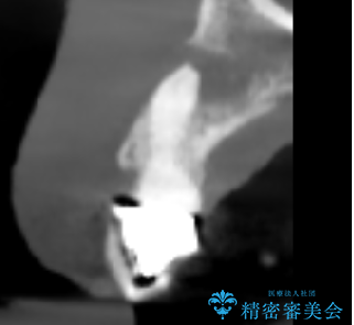 歯茎の腫れが気になる方必見!|抜歯即時インプラントで前歯5本を痛みなく3か月で治療完了!の治療中
