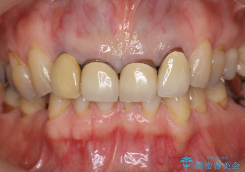 境目の見える前歯をきれいにしたい セラミック治療の治療前