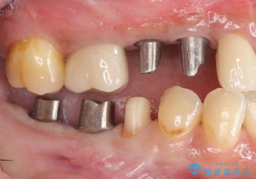 長期的な予後を見据えたインプラント治療の治療中