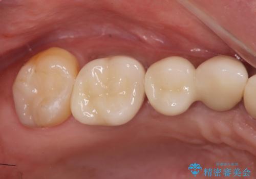 長期的な予後を見据えたインプラント治療の治療後