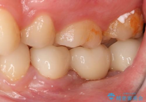 銀歯をやり変えたい フルジルコニアブリッジの治療後