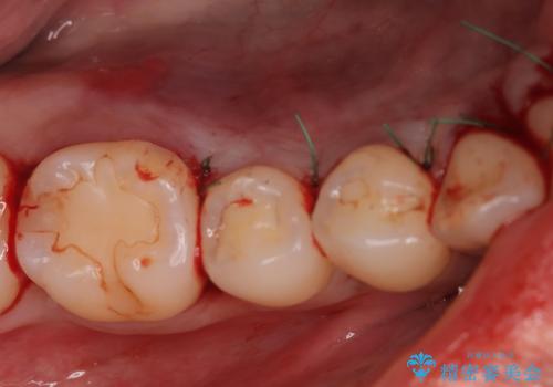 骨隆起を取りたいの治療中
