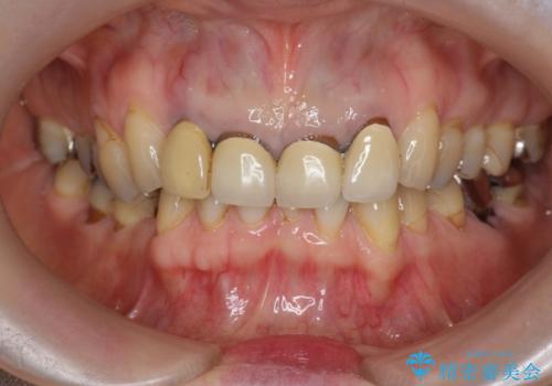 境目の見える前歯をきれいにしたい セラミック治療の治療前