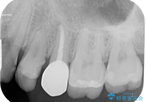 左上に違和感がある セラミックインレー修復の治療前