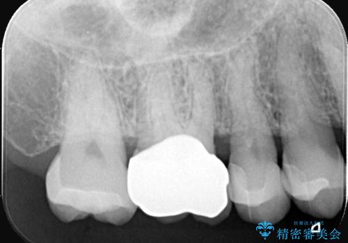 奥歯の銀歯を自然なセラミックに。安心のメタルフリー治療の治療後