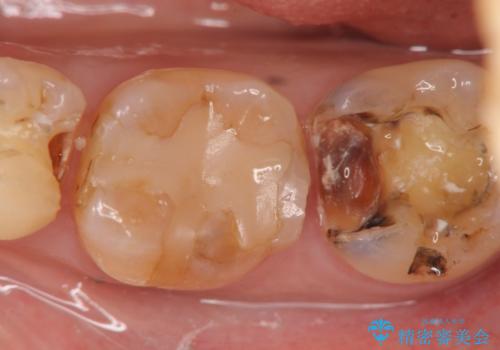 銀歯の下で虫歯の再発 拡大鏡下で行う虫歯の精密治療の治療中