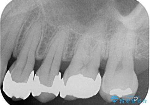 矯正が終わったのでセラミックに変えていきたい オールセラミッククラウンの治療前