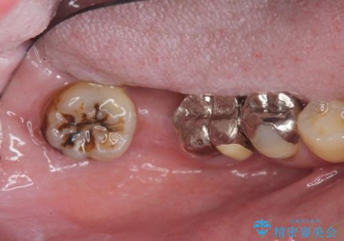 長期的な予後を見据えたインプラント治療の治療前